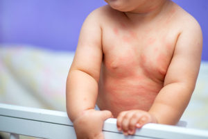 baby skin allergy home remedy